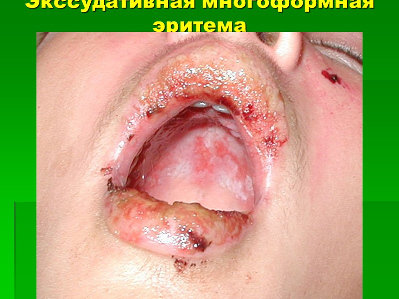 Экссудативная многоформная эритема